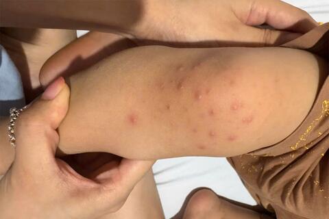 Hà Nội chủ động đẩy lùi bệnh tay chân miệng