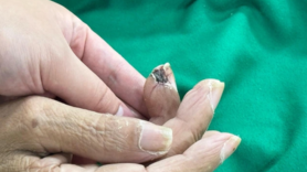 Không nên coi thường những vết thương nhỏ