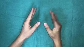 Lần đầu tiên tại Việt Nam: Vi phẫu thuật thành công cứu sống ngón tay thủy thủ bị đứt rời sau 25 giờ