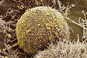 Nữ bệnh nhân HIV được chữa khỏi nhờ phương pháp mới