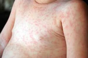 Tăng cường giám sát ca sốt phát ban nghi sởi, rubella