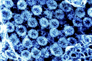 Virus gây bệnh Covid-19 có thể gây viêm não tương tự bệnh Parkinson