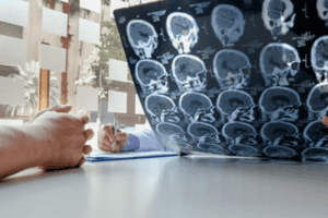 AI giúp chẩn đoán sớm và tìm ra phương pháp điều trị cho người đột quỵ