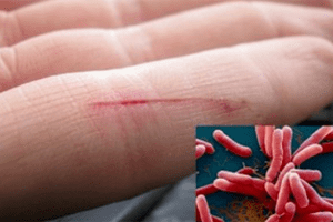 Thanh Hóa đã phát hiện một người mắc bệnh “Vi khuẩn ăn thịt người”