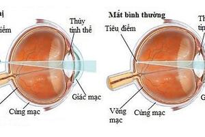 Nguyên nhân gây viễn thị và cách điều trị