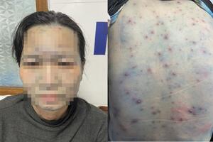 Bệnh nhân mắc thủy đậu có bệnh nền dễ bị biến chứng