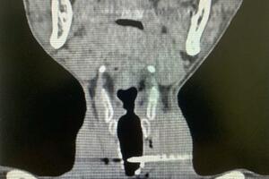 Bệnh viện Trung ương Quân đội 108: Cứu sống bệnh nhân bị vết thương khí quản xuyên thấu phức tạp