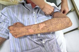 Bỏng rát toàn thân, mù tạm thời vì silicon