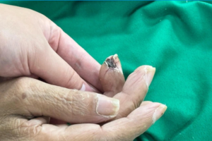 Không nên coi thường những vết thương nhỏ