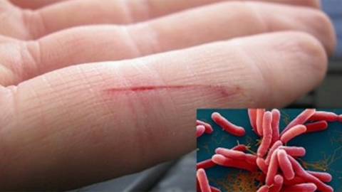 Thanh Hóa đã phát hiện một người mắc bệnh “Vi khuẩn ăn thịt người”