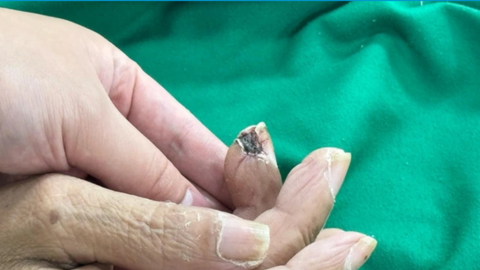 Không nên coi thường những vết thương nhỏ