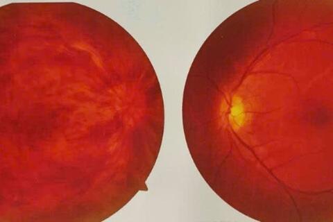 Cảnh báo nguy cơ gây mù lòa từ bệnh lý tắc tĩnh mạch trung tâm võng mạc